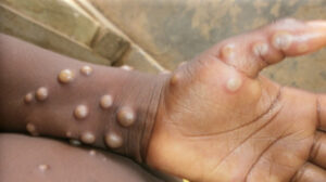 monkeypox-300x168 MPOX : 5 Things You Should Know About MPOX